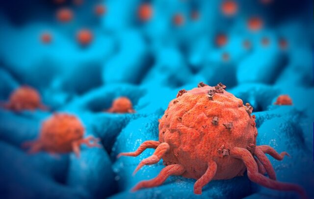 تشخیص به‌هنگام مهمترین اصل درمان سرطان روده