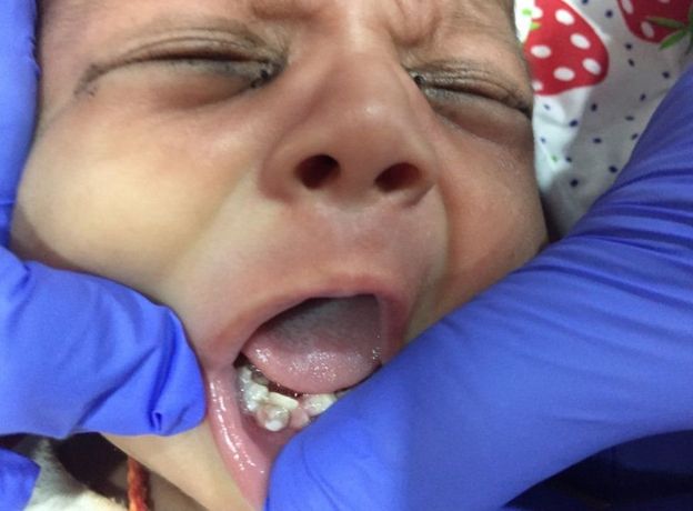 پزشکان هندی هفت دندان نوزاد یک ماهه را کشیدند